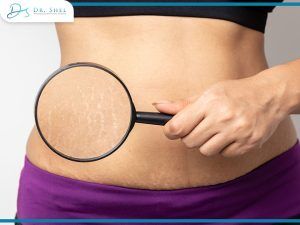 There's Finally Hope for Cellulite Removal, and It's Non-Surgical! - Dr. Shel Wellness & Aesthetic Center There's Finally Hope for Cellulite Removal, and It's Non-Surgical! - Dr. Shel Wellness & Aesthetic Center